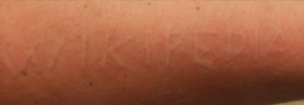 Signs of Sun Poisoning: How to Recognize the Symptoms