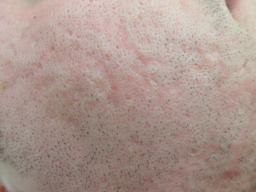 A Breakthrough: Acne Moisturizer Enigmatically Tackles Skin Woes